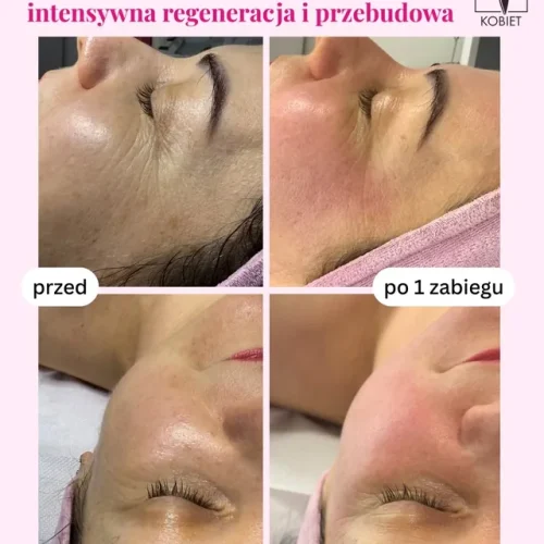 Mikroigły 2