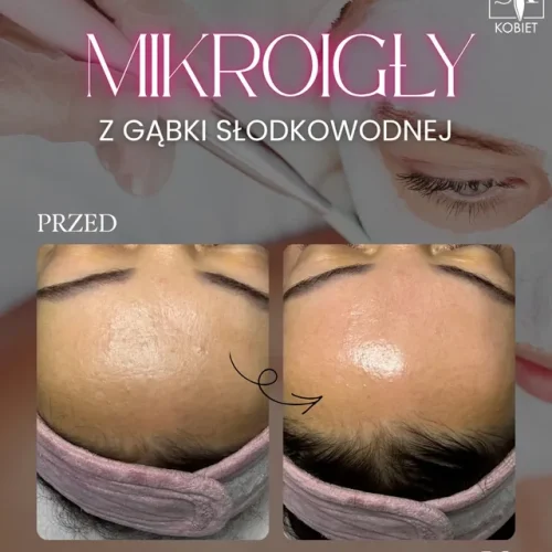 Mikroigły