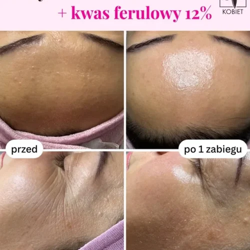 Oczyszczanie wodorowe i kwas ferulowy