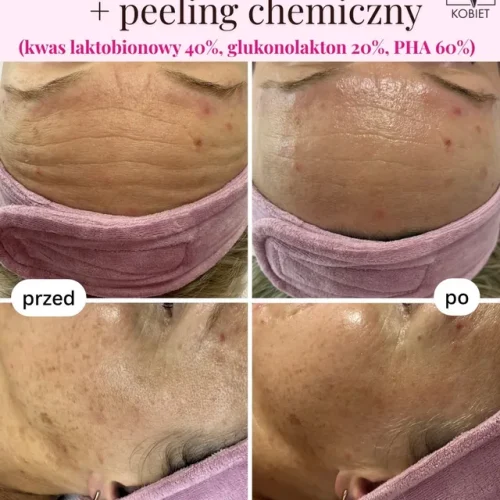 Oczyszczanie wodorowe i peeling chemiczny