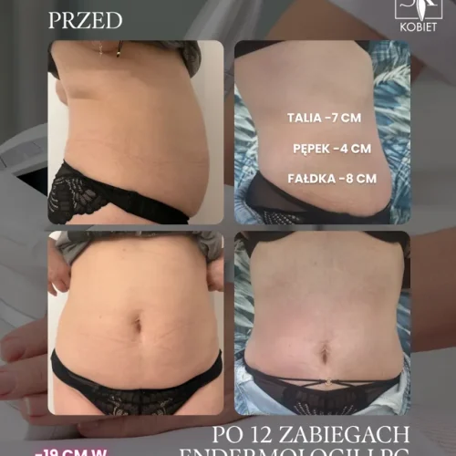 endermologia-lpg-brzuch-12-zabiegow-minus-19-cm-01