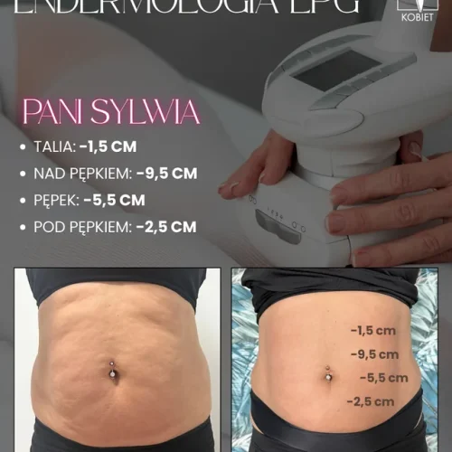 endermologia-lpg-brzuch-12-zabiegow-minus-19-cm-02