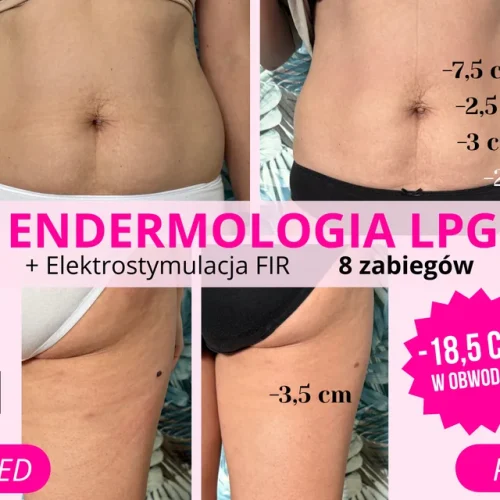 endermologia-lpg-elektrostymulacja-fir-brzuch-8-zabiegow-minus-18-5-cm