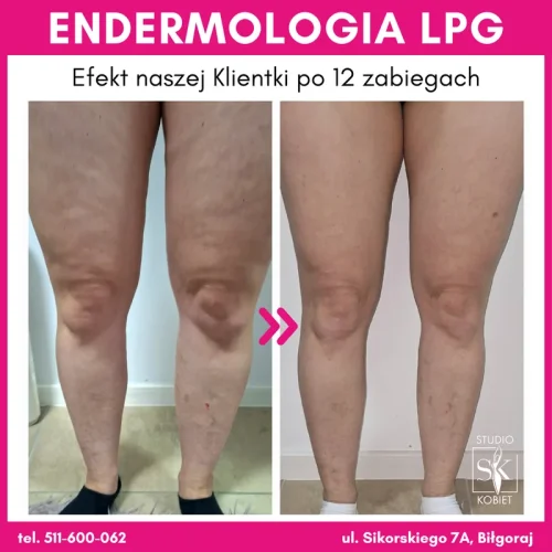 endermologia-lpg-nogi-12-zabiegow-efekt-przed-po