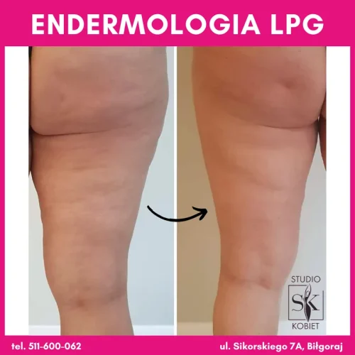 endermologia-lpg-uda-efekt-przed-po