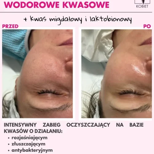 jadeitowe oczyszczanie wodorowe kwasowe