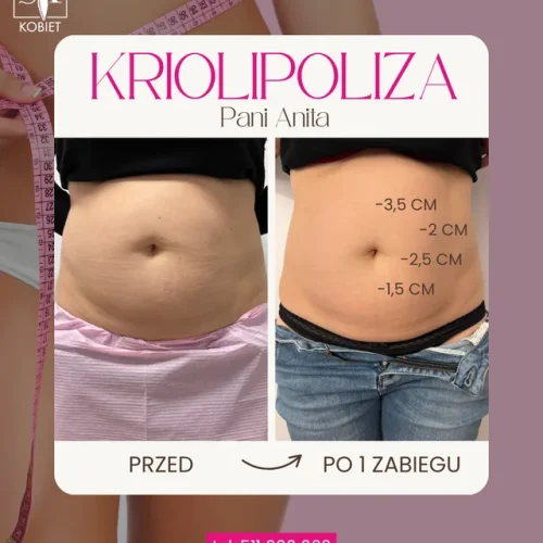 kriolipoliza-brzuch-1-zabieg-minus-9-5-cm