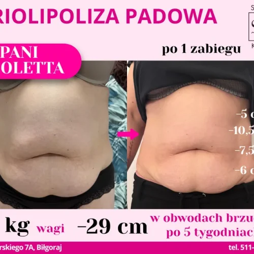 kriolipoliza-padowa-brzuch-1-zabieg-minus-29-cm-minus-5-kg-5-tygodni