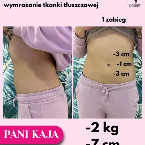 kriolipoliza-padowa-brzuch-1-zabieg-minus-7-cm-minus-2-kg