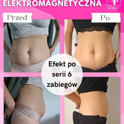 meltivio-fala-elektromagnetyczna-brzuch-6-zabiegow-efekt-przed-po