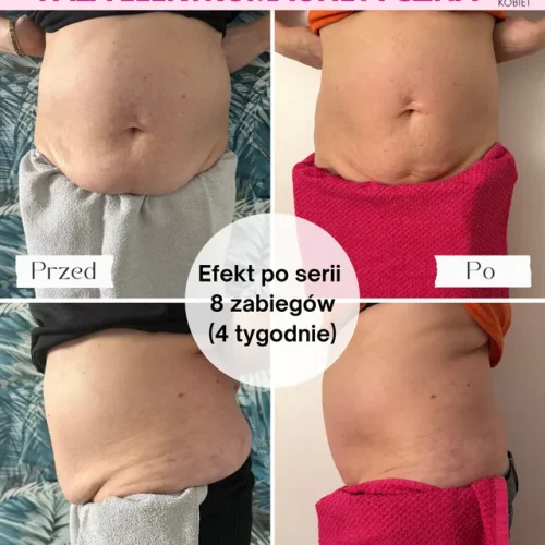meltivio-fala-elektromagnetyczna-brzuch-8-zabiegow-4-tygodnie-efekt-przed-po